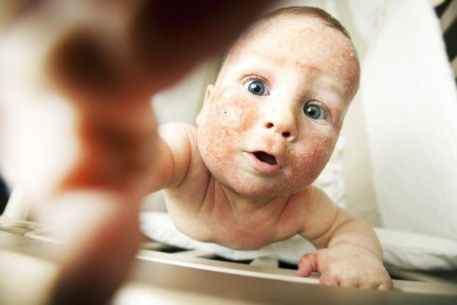 תינוק סובל מאטופיק דרמטיטיס המתבטאת בפריחה אקזמטית בעור הפנים